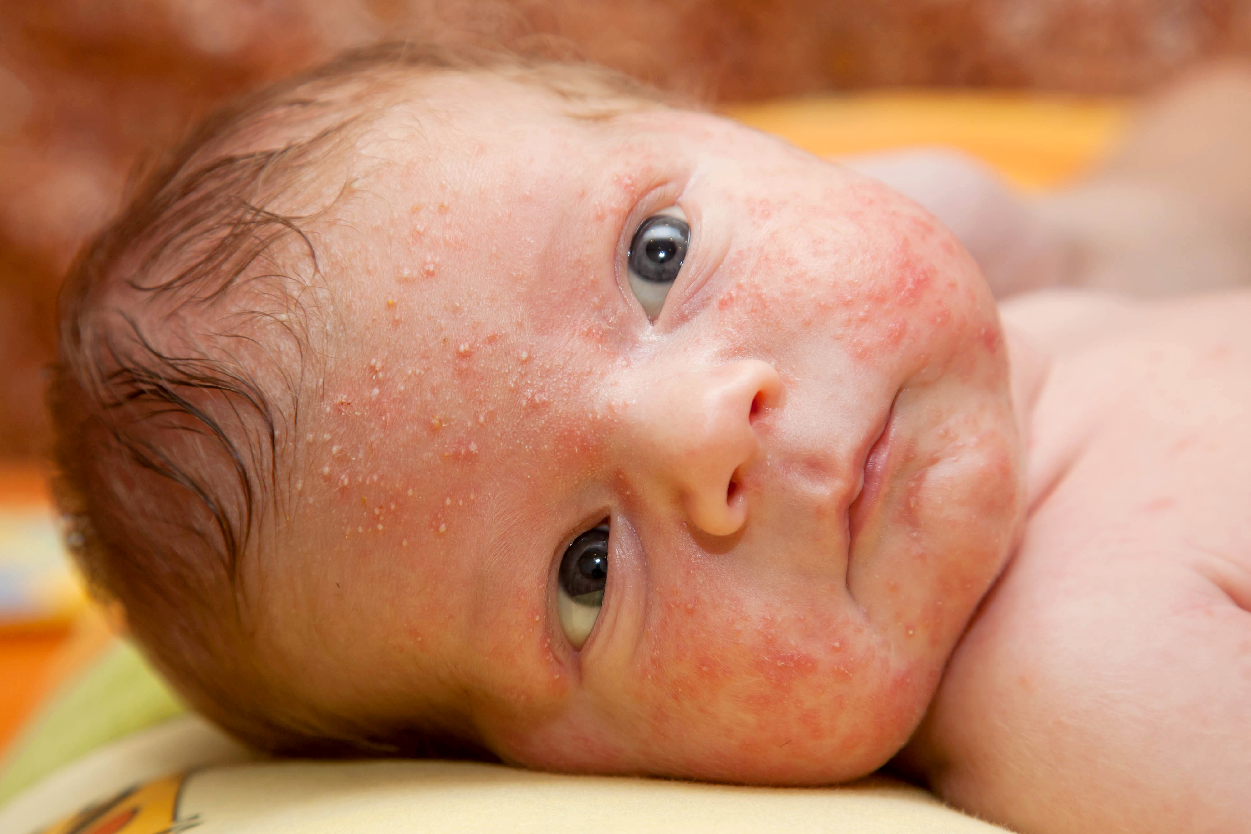 My baby has a rash :: Hertfordshire and West Essex Healthier Together
