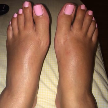 Swollen Ankles Feet And Fingers In Pregnancy Hertfordshire And West Essex Healthier Together