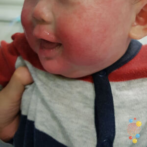 Photo of baby with rash 