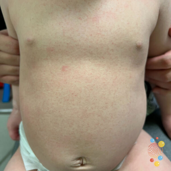 Parents and carers asked to be aware of the symptoms of scarlet fever