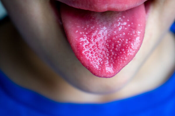 Parents and carers asked to be aware of the symptoms of scarlet fever
